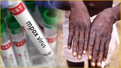 first suspected case of mpox sparks concerns in india  check what health ministry says