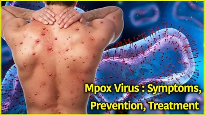 mpox virus outbreak  causes  symptoms and prevention  all you need to know