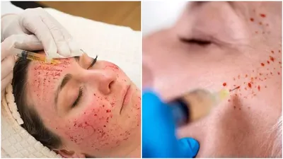 vampire facial  a new trend that left three women infected with hiv