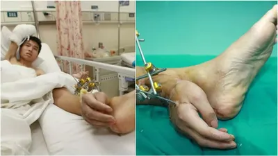 groundbreaking surgery  man s hand transplanted to ankle after tragic accident