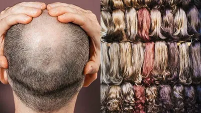 as china battles baldness  ed exposes rs 11 793 crore hair smuggling racket